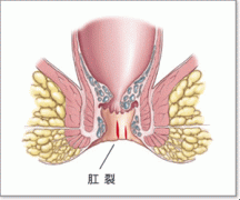 肛裂早期有什么症状