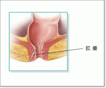 肛瘘的五大临床症状