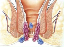 不同症状外痔的表现